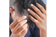 Image Man holding his hands in his head while showing hair loss in the forefront.
